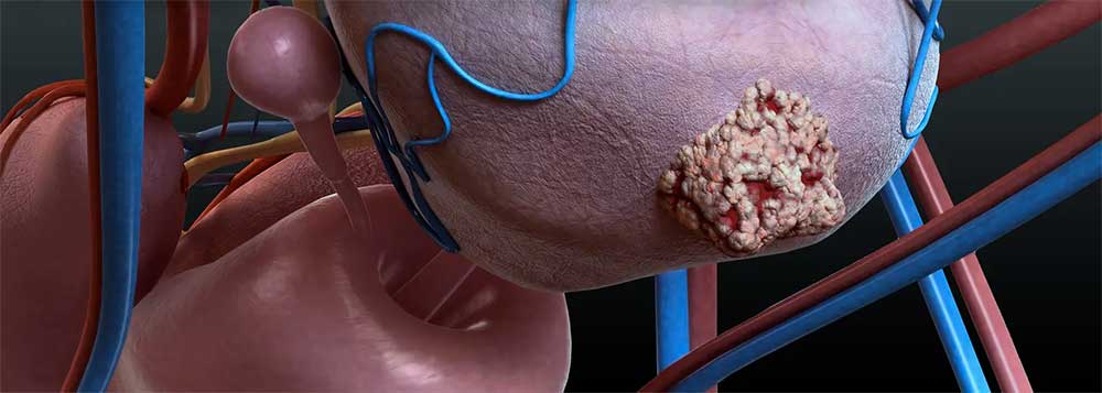 rak-prostate